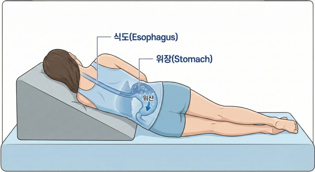 역류성 식도염 예방을 위해 왼쪽으로 누워 자는 올바른 수면 자세
